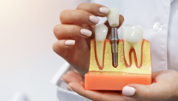 Dental-Implants