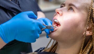 Gentle-Teeth-Extraction-in-Caledonia-Expert-Care-&-Comfort