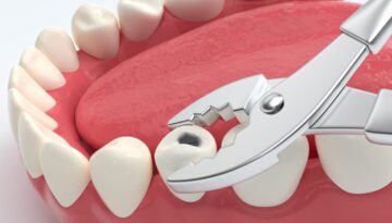 Why-Choose-Our-Dental-Clinic-for-Wisdom-Teeth-Removal-in-Caledonia