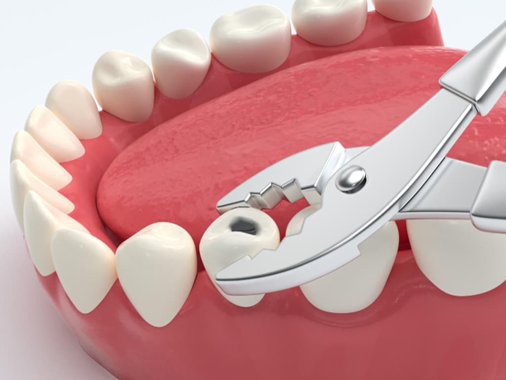 Why-Choose-Our-Dental-Clinic-for-Wisdom-Teeth-Removal-in-Caledonia
