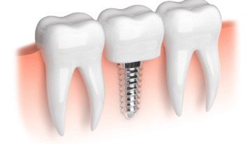 Dental Implants and Orthodontics in Caledonia Coordinating Care for a Perfect Smile