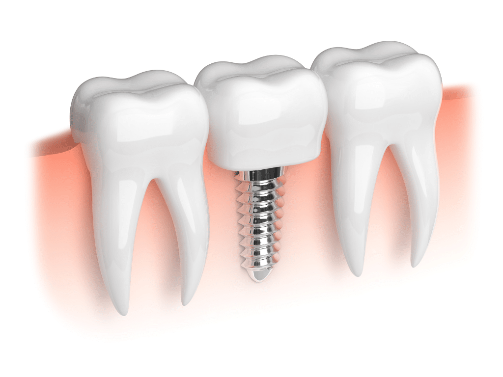 Dental Implants and Orthodontics in Caledonia Coordinating Care for a Perfect Smile
