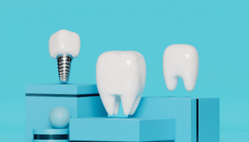 Dental Implants in Caledonia A Permanent Solution for Missing Teeth