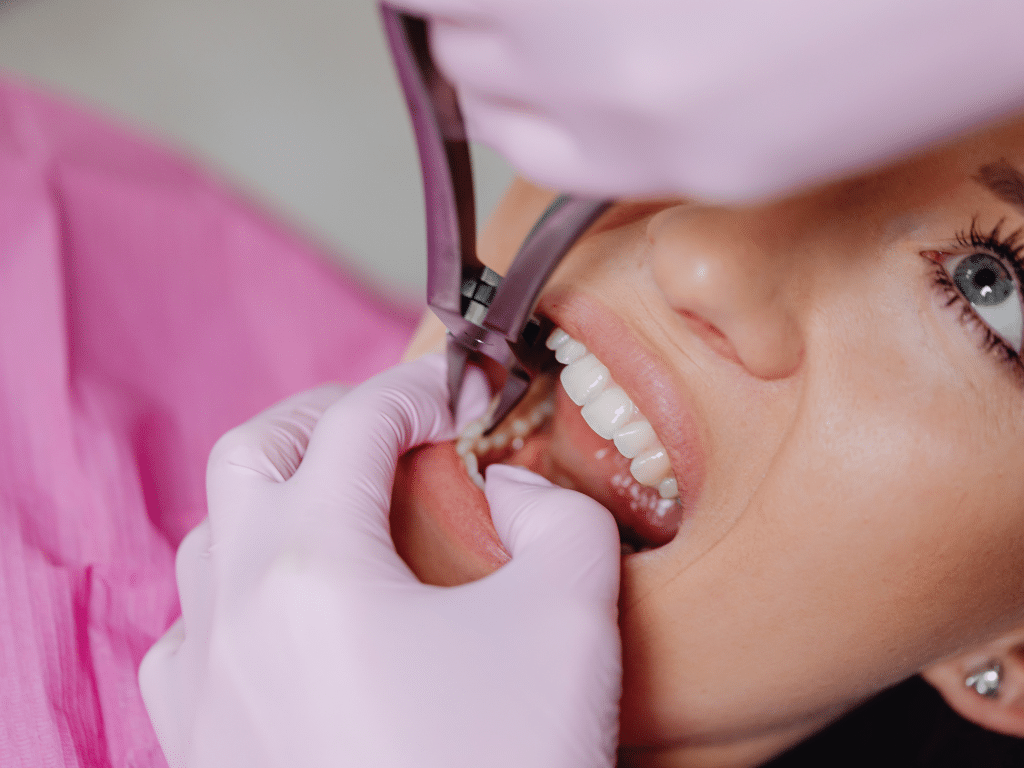 Emergency Teeth Extractions in Caledonia What to Expect and How to Recover