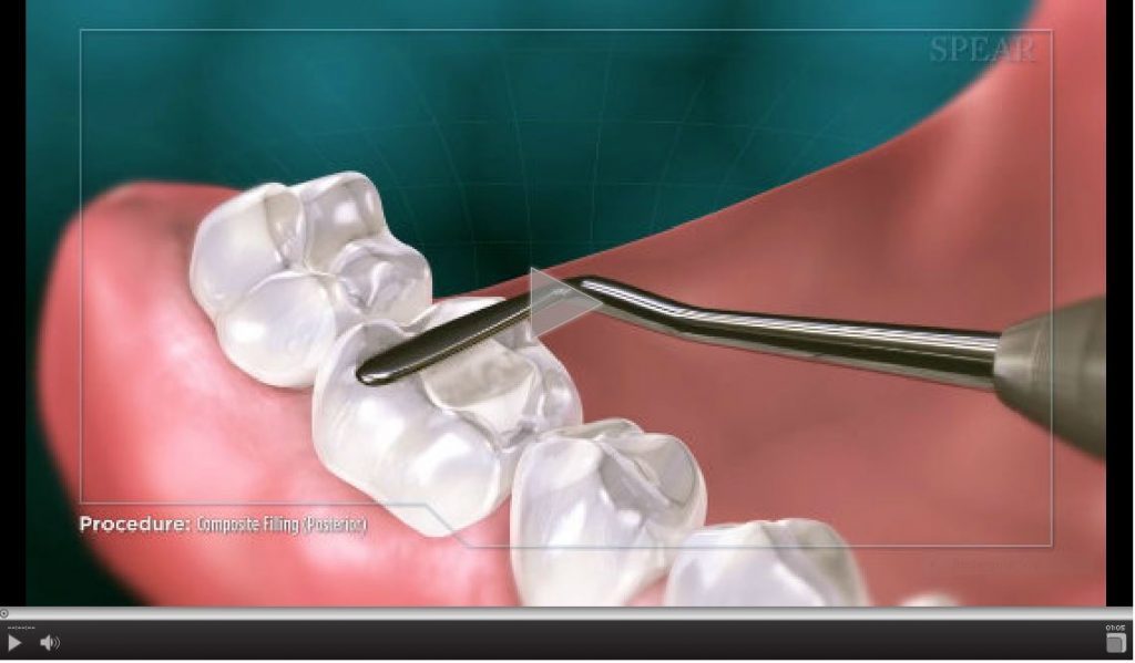 compositefillingposterior1024×599 Caledonia Medical Plex