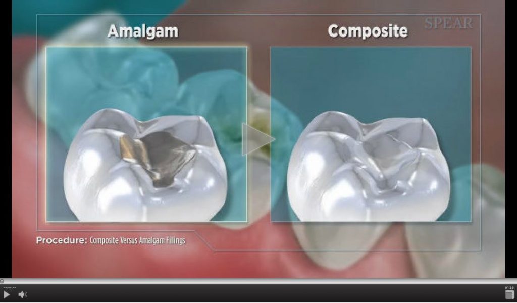 compositeversusamalgamfilling11024×600 Caledonia Medical Plex