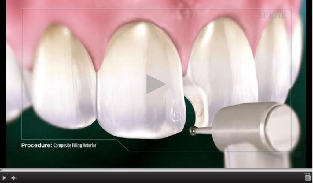 compositeversusamalgamfilling1024×598 Caledonia Medical Plex