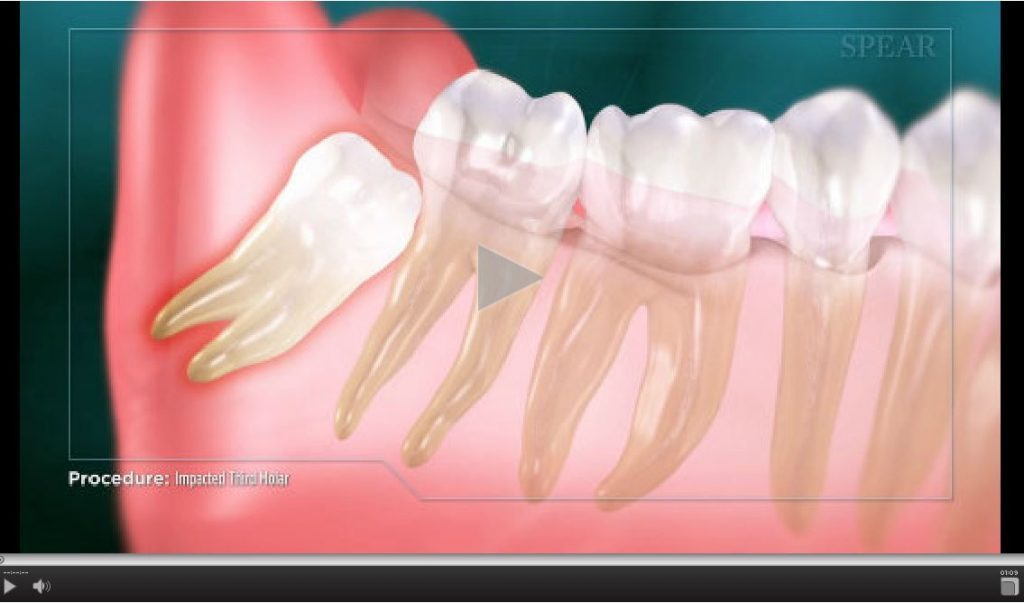 impactedthirdmolar1024×603 Caledonia Medical Plex