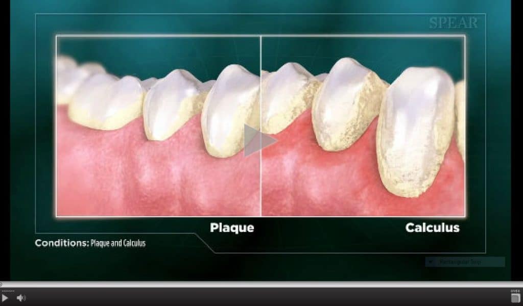 dental calculus classification