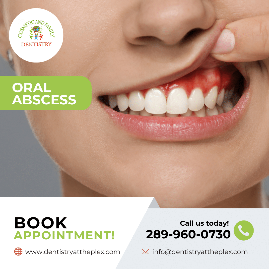 Oral Abscess