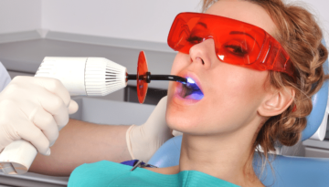 Tooth-Coloured-Fillings