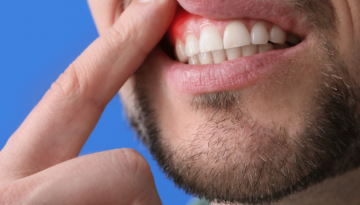oral abscess