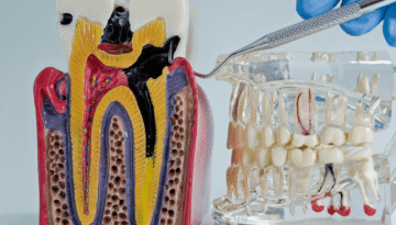 DATP Root Canal 2