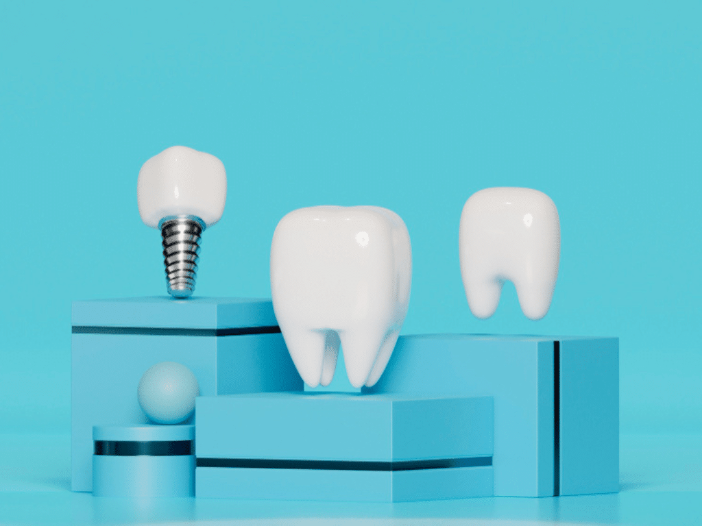 Dental Implants in Caledonia A Permanent Solution for Missing Teeth